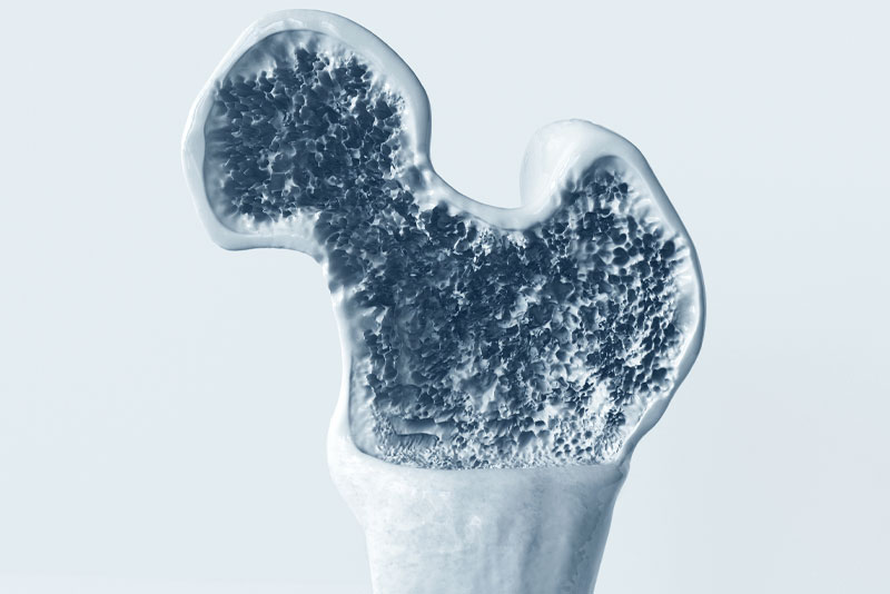 骨粗鬆症の治療